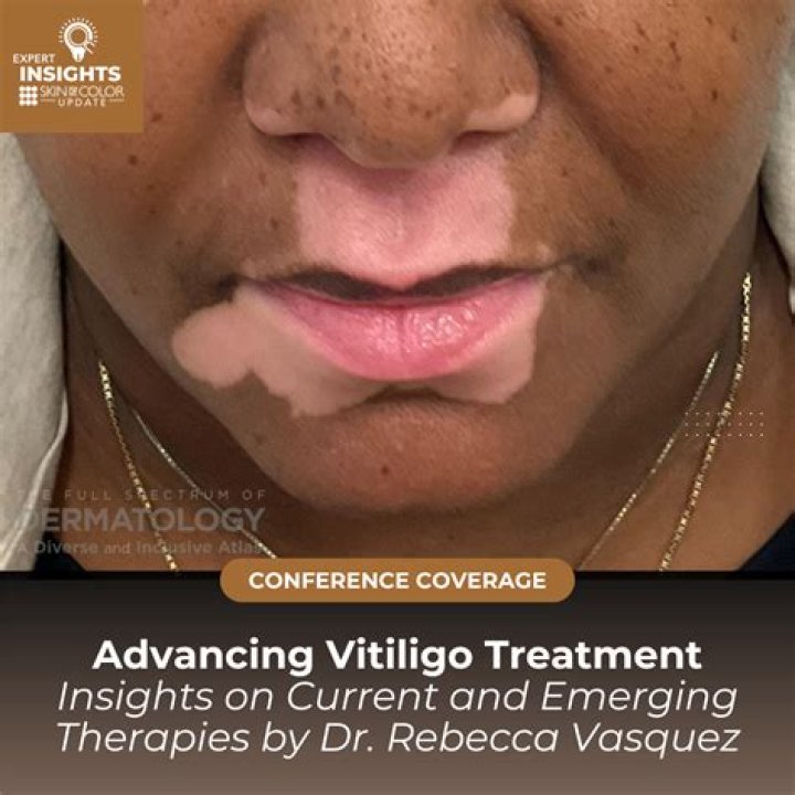Can PABA cause vitiligo? | ContextResponse.com